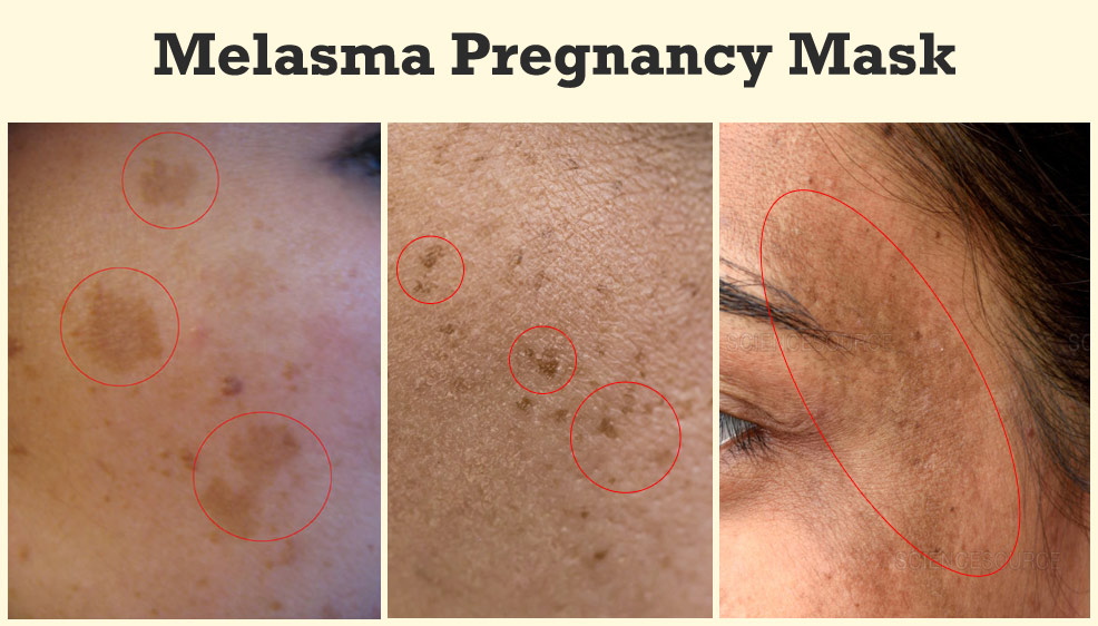 melasma pregnancy mask skin discoloration