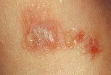 contact dermatitis