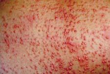 baby heat rash