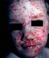 impetigo