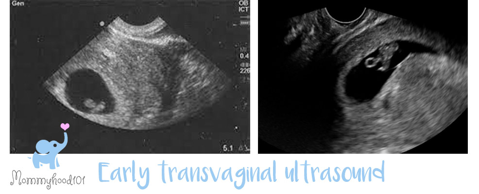 transvaginal ultrasound embryo pregnancy